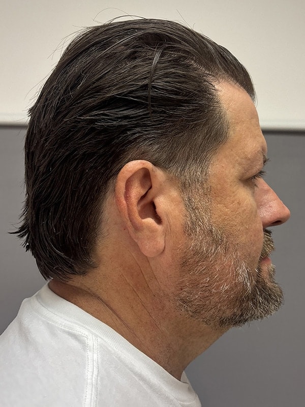 Blepharoplasty Before & After Image