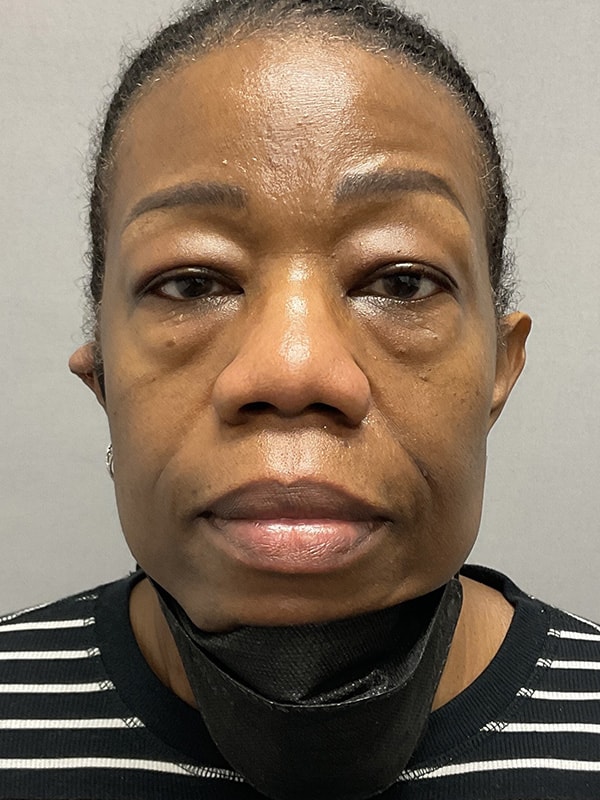 Blepharoplasty Before & After Image