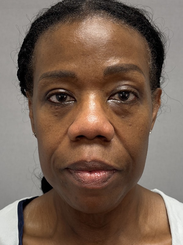 Blepharoplasty Before & After Image