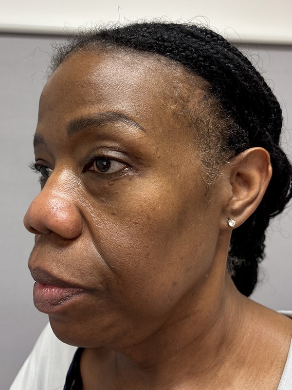 Blepharoplasty Before & After Image