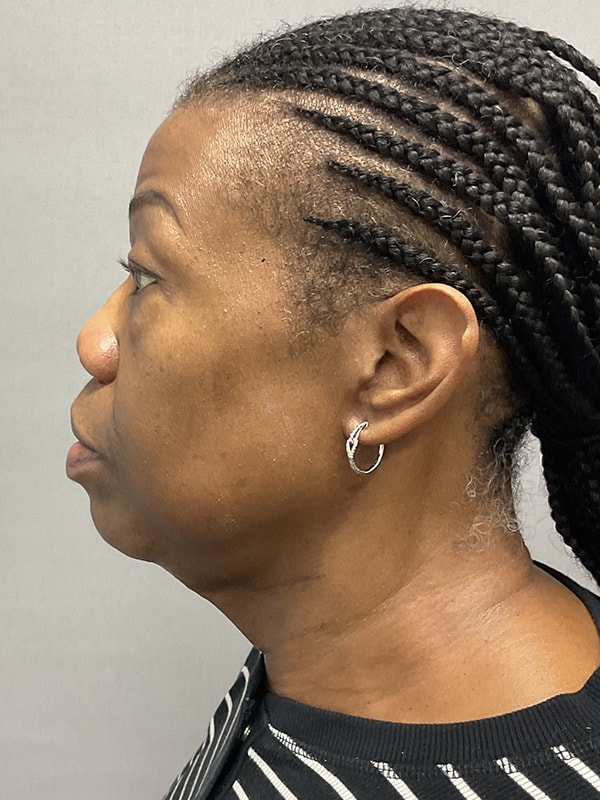 Blepharoplasty Before & After Image