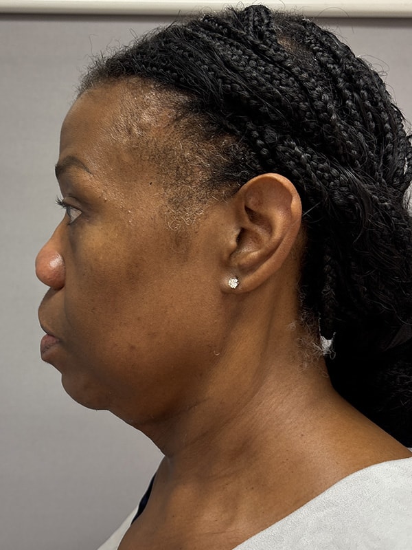 Blepharoplasty Before & After Image