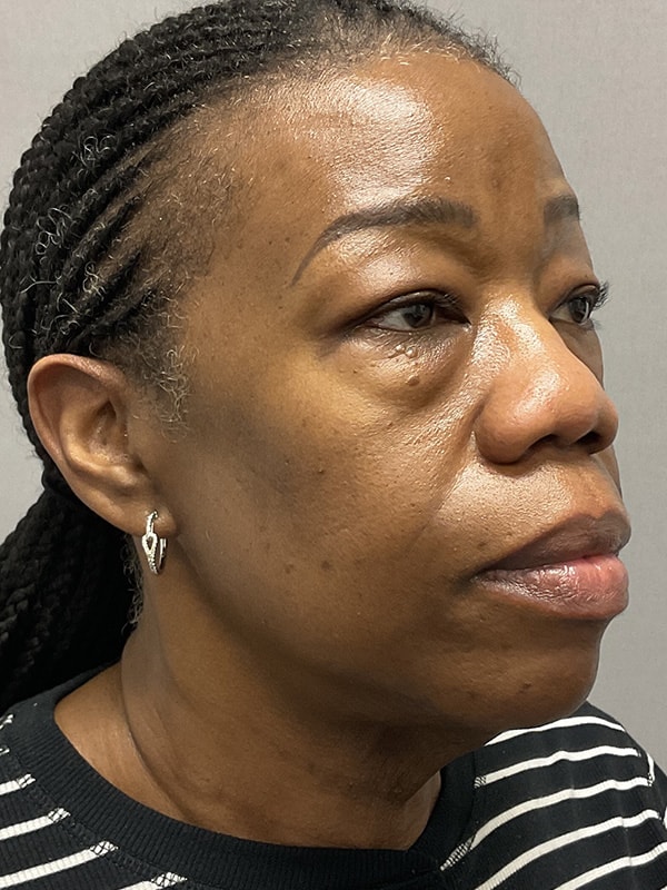 Blepharoplasty Before & After Image