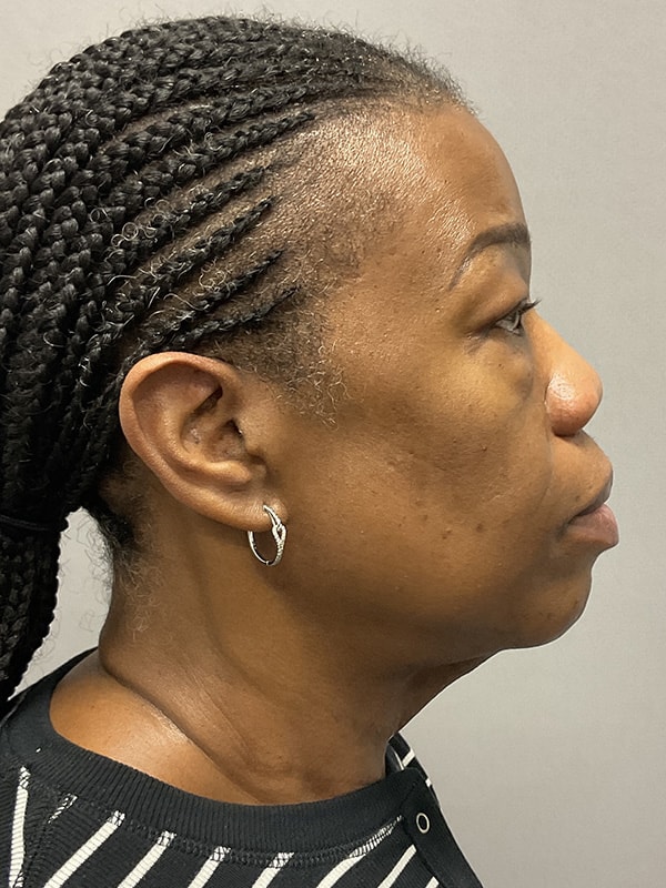Blepharoplasty Before & After Image