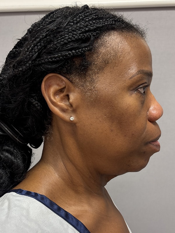 Blepharoplasty Before & After Image