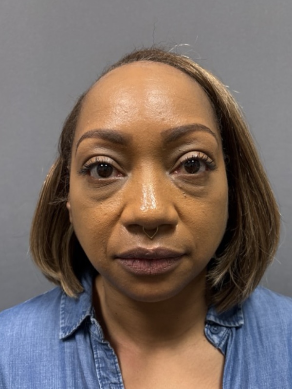 Blepharoplasty Before & After Image