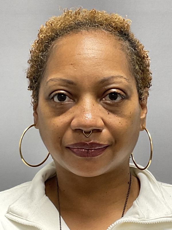 Blepharoplasty Before & After Image