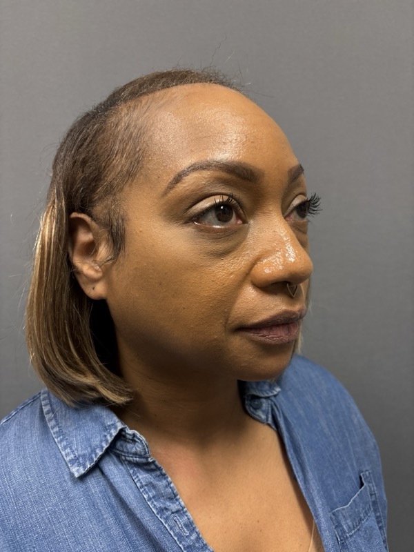 Blepharoplasty Before & After Image
