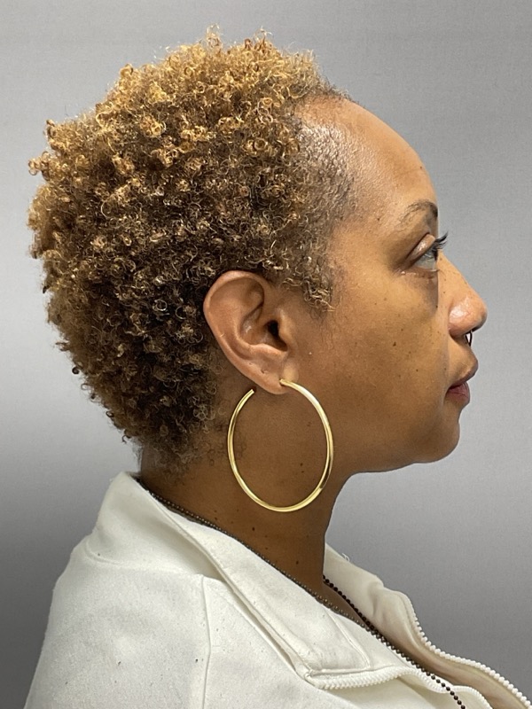 Blepharoplasty Before & After Image