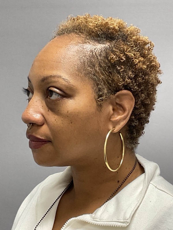Blepharoplasty Before & After Image