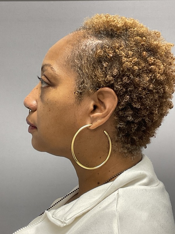 Blepharoplasty Before & After Image