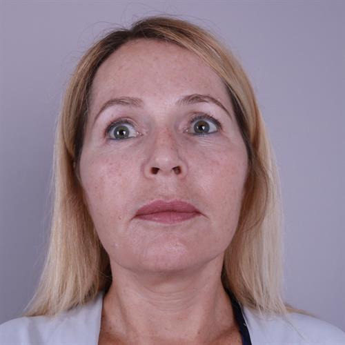 Facelift Before & After Image