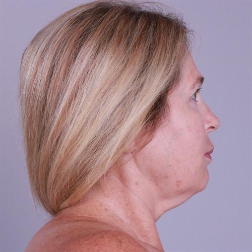 Facelift Before & After Image