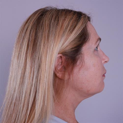 Facelift Before & After Image