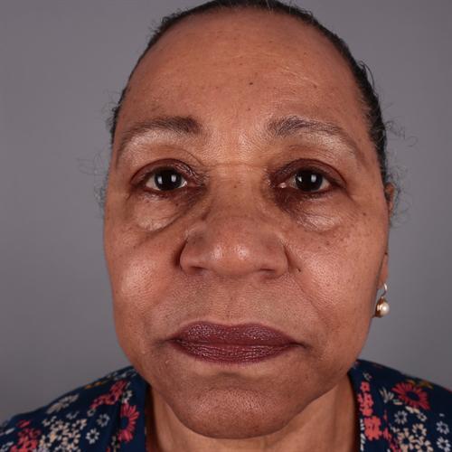 Facelift Before & After Image