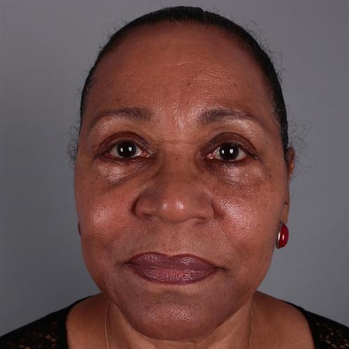 Facelift Before & After Image