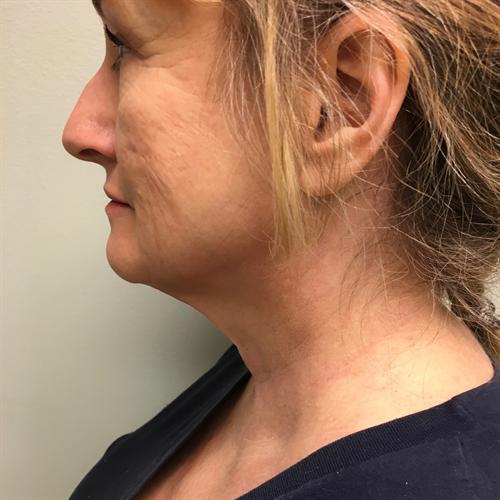 Facelift Before & After Image