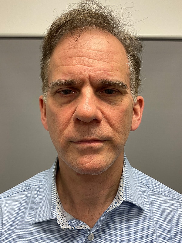 Facelift Before & After Image