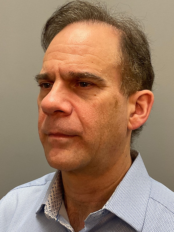 Facelift Before & After Image