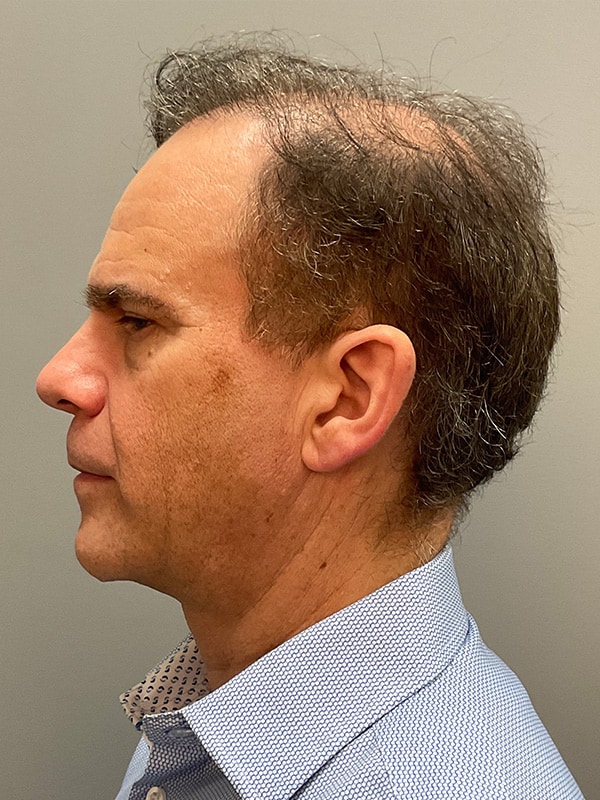 Facelift Before & After Image