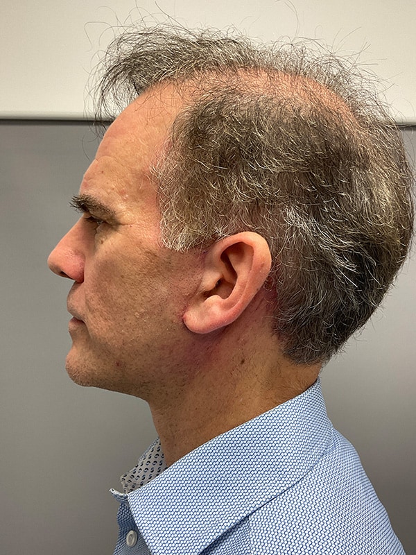 Facelift Before & After Image