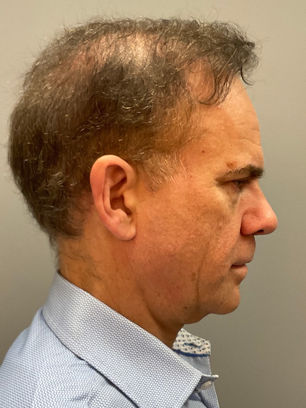 Facelift Before & After Image