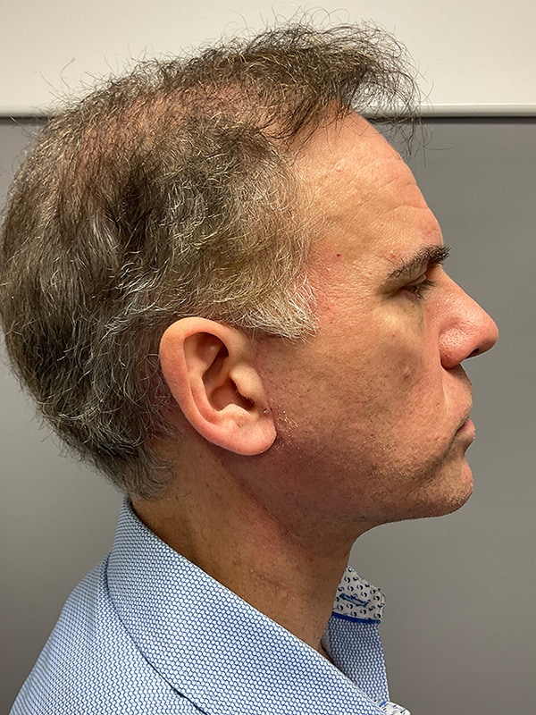 Facelift Before & After Image