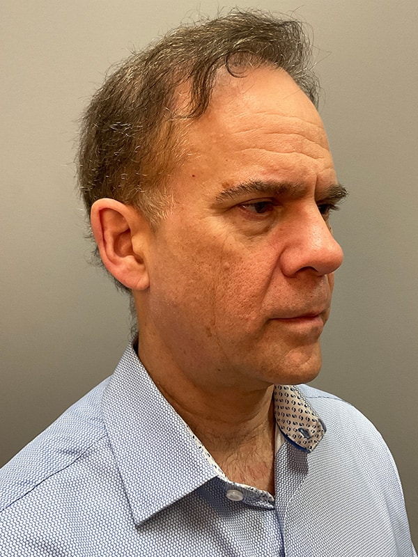 Facelift Before & After Image