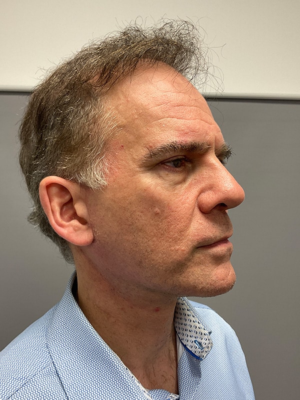 Facelift Before & After Image