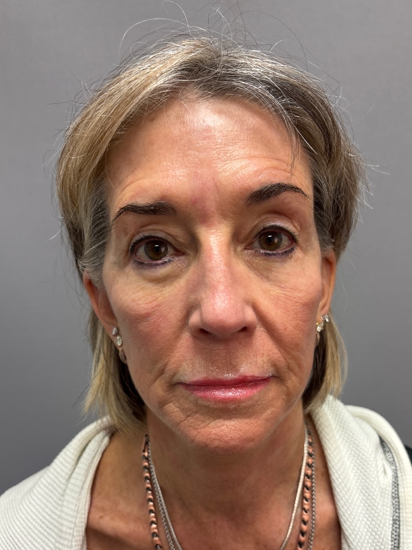 Facelift Before & After Image