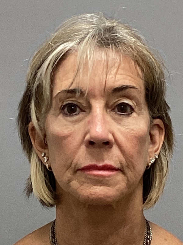 Facelift Before & After Image
