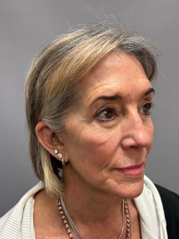 Facelift Before & After Image