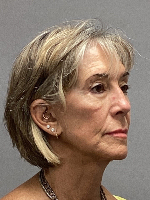 Facelift Before & After Image