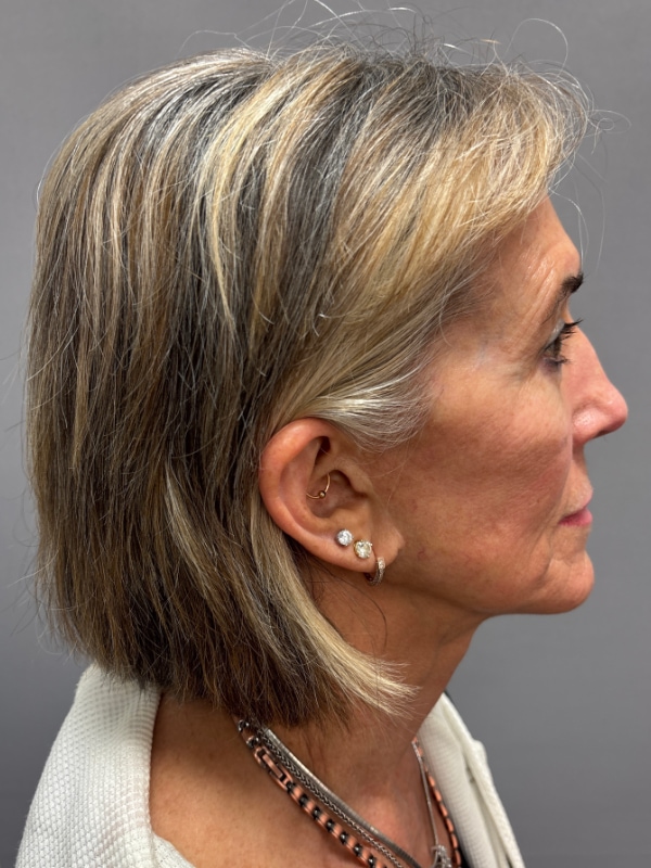 Facelift Before & After Image