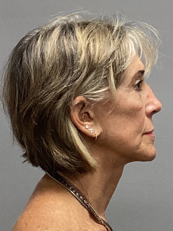 Facelift Before & After Image