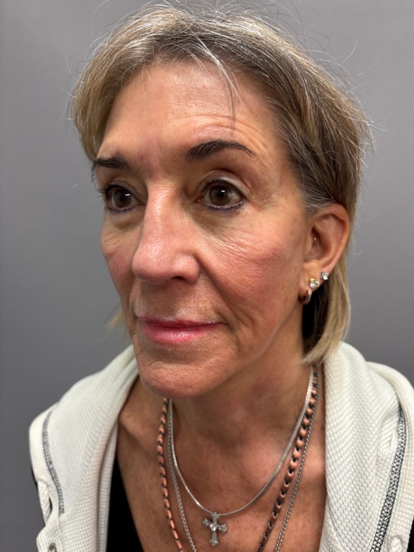 Facelift Before & After Image