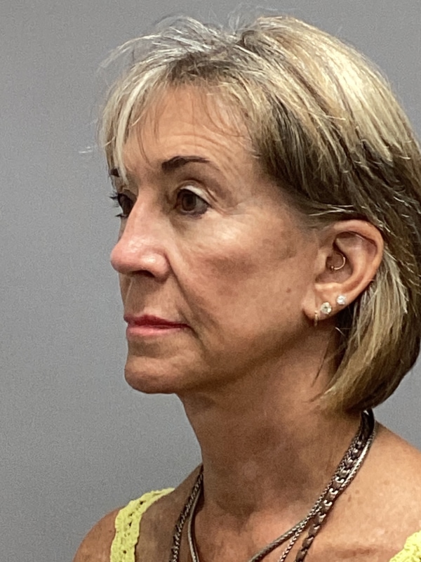 Facelift Before & After Image