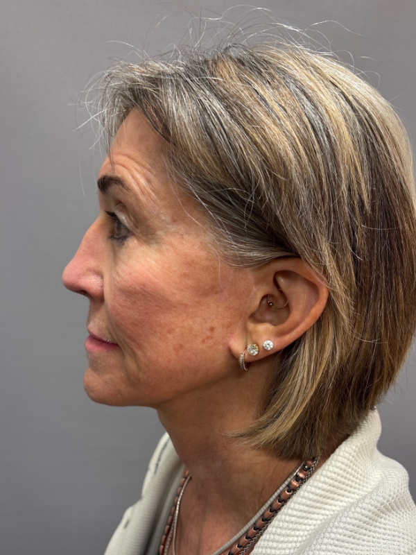 Facelift Before & After Image