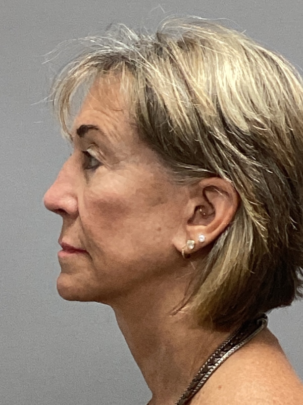 Facelift Before & After Image