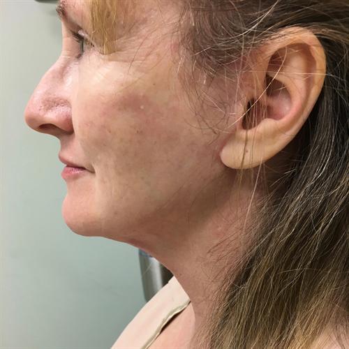 Neck Lift Before & After Image