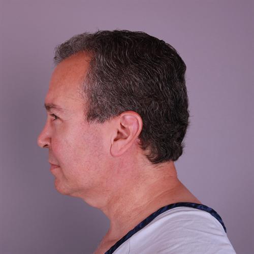 Neck Lift Before & After Image