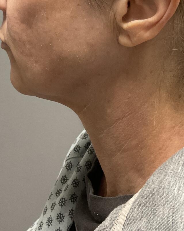 neck lift Before & After Image
