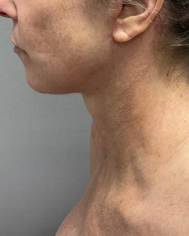 neck lift Before & After Image