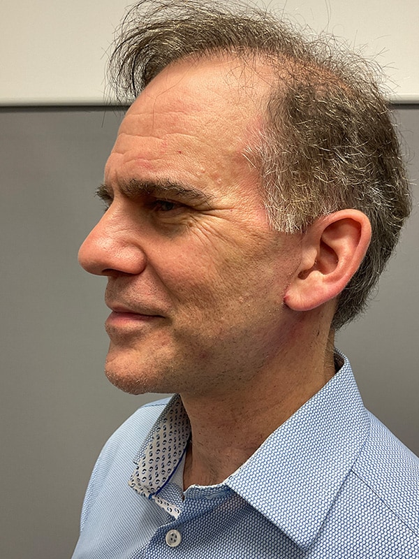 Neck Lift Before & After Image