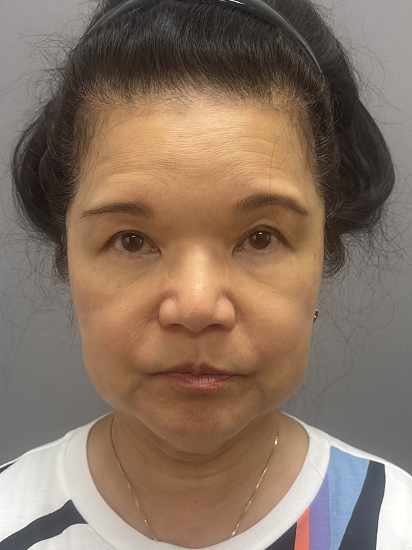 Neck Lift Before & After Image