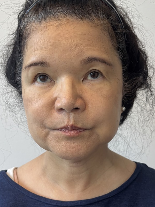 Neck Lift Before & After Image