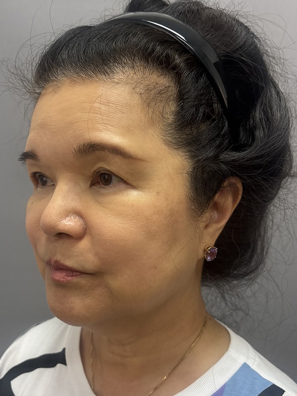 Neck Lift Before & After Image