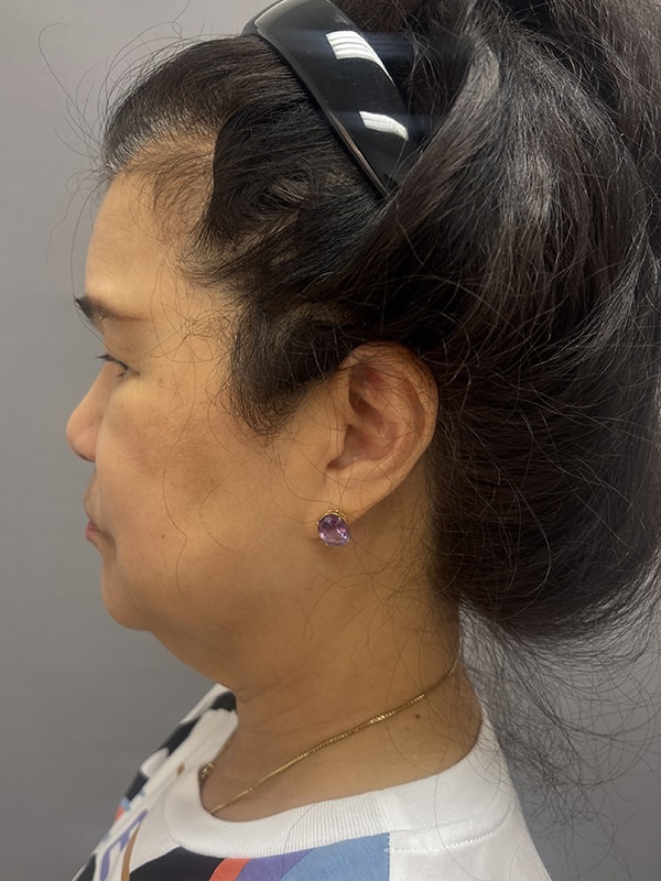 Neck Lift Before & After Image