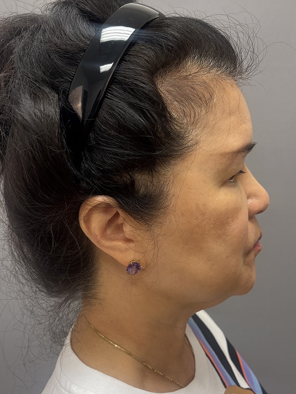 Neck Lift Before & After Image