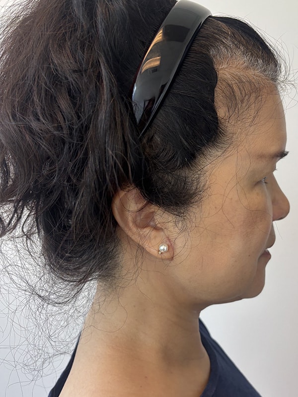 Neck Lift Before & After Image